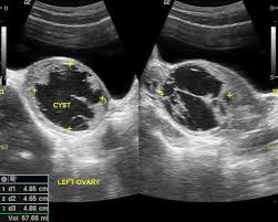 Ovarian Torsion Radiology Case Radiopaedia Org Ultrasound Tech Radiology Diagnostic Medical Sonography