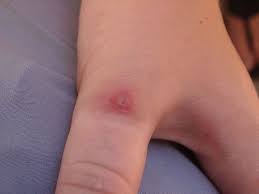 Some people are slightly affected by the venom, but others the first symptom is acute pain at the site of the bite though there may only be a minimal local reaction. Pin On Debbie