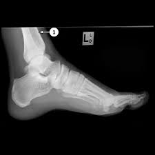 The lateral malleolus is the bone marking that can be palpated at the distal end of the fibula. Foot X Ray Labeling Questions Radiology Case Radiopaedia Org