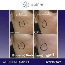 Trulum skin care (jujur tanpa rekayasa). Trulum 10ml Krim Jerawat Ampuh Obat Jerawat Paling Ampuh Pembersih Wajah Wanita Perawatan Wajah Perawatan Kecantikan Bukalapak Com Inkuiri Com