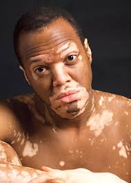 File:Vitiligo misto.jpg