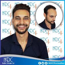 Genc Yasta Saclarini Kaybeden Mirac Ozay Hdc Protez Sac Sistemleri Ile Saclarina Tekrar Kavustu Hdc Sac Sacdokulmesi Sackaybi Sac Sac Dokulmesi Gencler