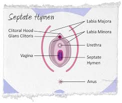 Get in a comfortable position and hold a tampon in your domi. Septate Hymen