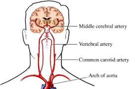 It's a less invasive procedure than a carotid endarterectomy because there's no need to make a cut in the neck. Carotid Artery Disease Treatment In Brighton Ma St Elizabeth S