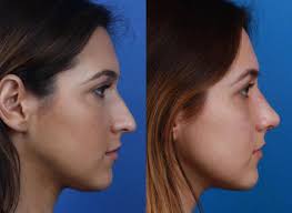 I've become slightly obsessed with having my nose done. What S Behind The Sudden Rise In Rhinoplasty Popularity Philip Miller Md