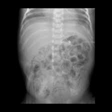 Image result for Necrotizing Enterocolitis