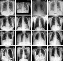 Deep Covid Predicting Covid 19 From Chest X Ray Images Using Deep Transfer Learning Sciencedirect