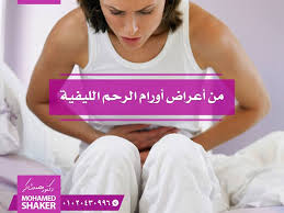 أورام الرحم الليفية Women