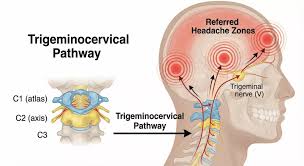 Image result for Spinal Headache