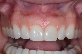 It's just one form of gum (periodontal) disease. I Got A Gum Transplant So I Could Have A Younger Smile