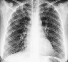 Clinical presentation bacterial pneumonia has symptoms similar to other pneumonia. Radiology Of Bacterial Pneumonia Sciencedirect