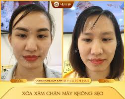 Mới Phun Xăm Lông Mày Thì Có Xóa Xăm Được Không? Viện Thẩm Mỹ Ladova