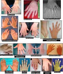 Pseudoacromegaly Sciencedirect