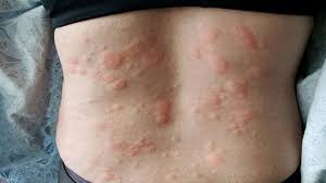 Image result for shingles in children