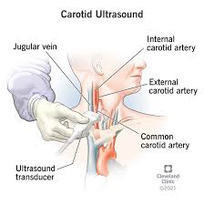 Image result for carotid artery