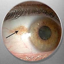 Image result for nevus sclerae