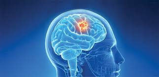 Workers in the nuclear industry have an increased risk of developing a brain tumor. Are Brain Tumors Increasing Painting Brain Tumor Cells To Improve Surgical Outcomes Although Brain Tumors Can