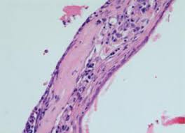 Image result for Myringosclerosis