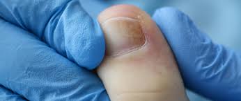 Image result for mykoza nehtů