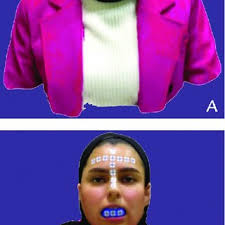 PDF) Dental implant placement with immersive technologies: A preliminary  clinical report of augmented and mixed reality applications