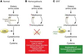 Image result for Homocystinuria