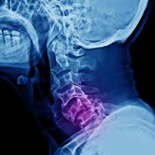 Your osteopath will quickly detect which facet joint is locked. Facet Joint Injury And Whiplash North Alabama Spine Rehab