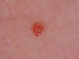 老人 性 血管 腫 画像