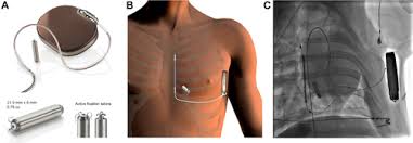 Which pacemaker/icd is that again. Acute And 3 Month Performance Of A Communicating Leadless Antitachycardia Pacemaker And Subcutaneous Implantable Defibrillator Jacc Clinical Electrophysiology