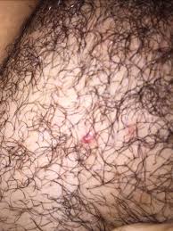 More than half of adults in the united states have oral herpes, and 1 in 8 people between the ages of 14 and 49 years have genital herpes. Ingrown Glow Community