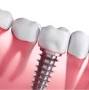 Single tooth implant cost from daytonabeachdentalimplants.com