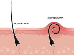 The bumps may look like pimples or cysts, and may be. Best Ingrown Hair Treatment Laser Hair Removal