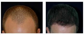 Each cell contains an exact copy of the original cell's chromosomes in their 23 pairs. Hair Stem Cell Yoskarn Clinic Plastic Surgery Thailand Cosmetic Surgery Thailand Breast Augmentation Thailand Nose Surgery Thailand Hormone Therapy Thailand Facelift Thailand