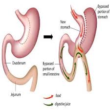 Pin On Bariatric Sleeve Surgery Info