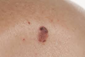 Red spots on skin can have many causes. What Do Red Spots On Skin Mean 13 Skin Spots Bumps Pictures