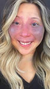 Haters made me hide my birthmark with make up... but not anymore 💪🏻