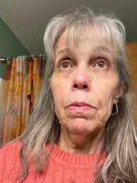 Faces of Neurofibromatosis