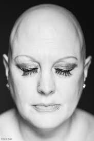 Powerful Photos Of People With Alopecia Prove Bald Is Beautiful