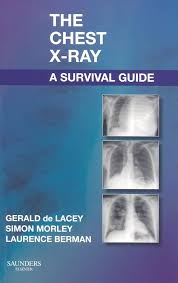 Image result for Chest XRay