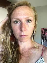 What is the best product for healing and scarring above lip after stitches  removal?