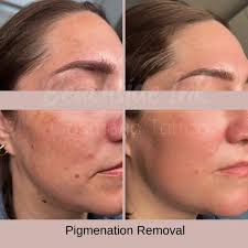 Want to know the 5 Reasons Why Fibroblast Treatments will Transform Your  Skin and Life?