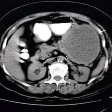 Check spelling or type a new query. Ct Imaging Features Of Abdominal Mesenteric Desmoid Tumour Eurorad