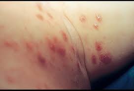 Mites form colonies and multiply quickly. Bites And Infestations Pictures Of Bug Bites Stings Allergies And Infections