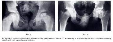 Legg Calve Perthes Disease Pediatrics Orthobullets