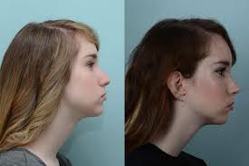 There may even be certain clauses first that needs to be fulfilled before the insurance is set to cover any amount of the surgery process. Rhinoplasty Johns Hopkins Facial Plastic And Reconstructive Surgery