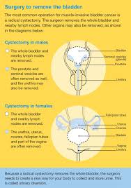 Chemotherapy (chemo) before surgery (with or without radiation) can shrink the tumor, which may make surgery easier. Bladder Cancer Treatment For Bladder Cancer Cancer Council