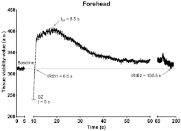 What does capillary refill mean? Diffuse Reflectance Spectroscopy Getting The Capillary Refill Test Under One S Thumb Protocol