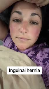 Showering After Inguinal Hernia Surgery