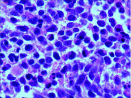 Small cell carcinoma is defined as a malignant epithelial tumor consisting of small cells with scant cytoplasm, defined cytoplasmic border, typical finely granular salt and pepper nuclear chromatin. Small Cell Neuroendocrine Carcinoma Of The Cervix In Pregnancy A Case Report And Review