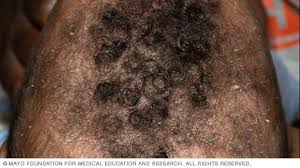 Image result for sores on the head in children