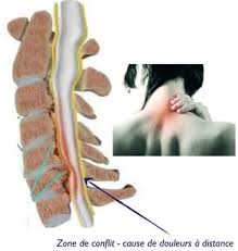 Les douleurs aux poignets en musculation est une blessure courante dans ce sport. Cervicalgies 2 Cercle Vicieux Orthopedie Pour Tous